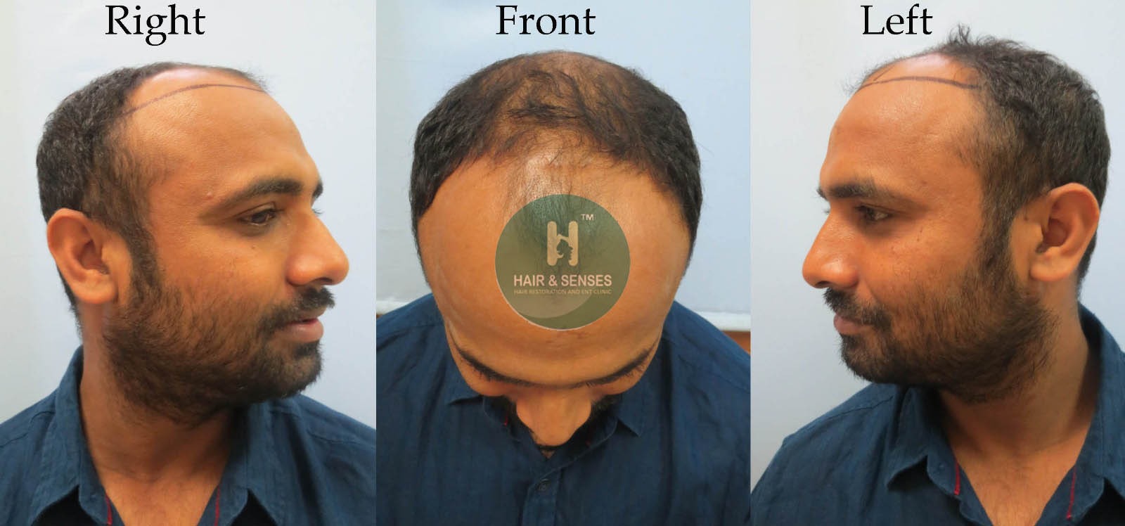 Before Procedure 5015